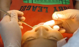 拔牙视频全过程,拔牙手术的惊心动魄瞬间